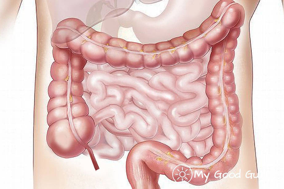 Diverticulosis And Diverticulitis Causes And Treatment My Good Gut