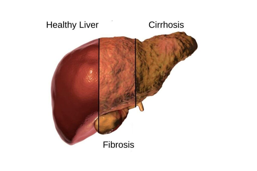 A diagram showcasing a healthy liver with signs of liver fibrosis.