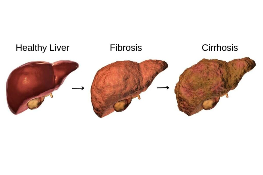 This guide provides information on liver fibrosis, its symptoms, and its association with cirrhosis in the liver.