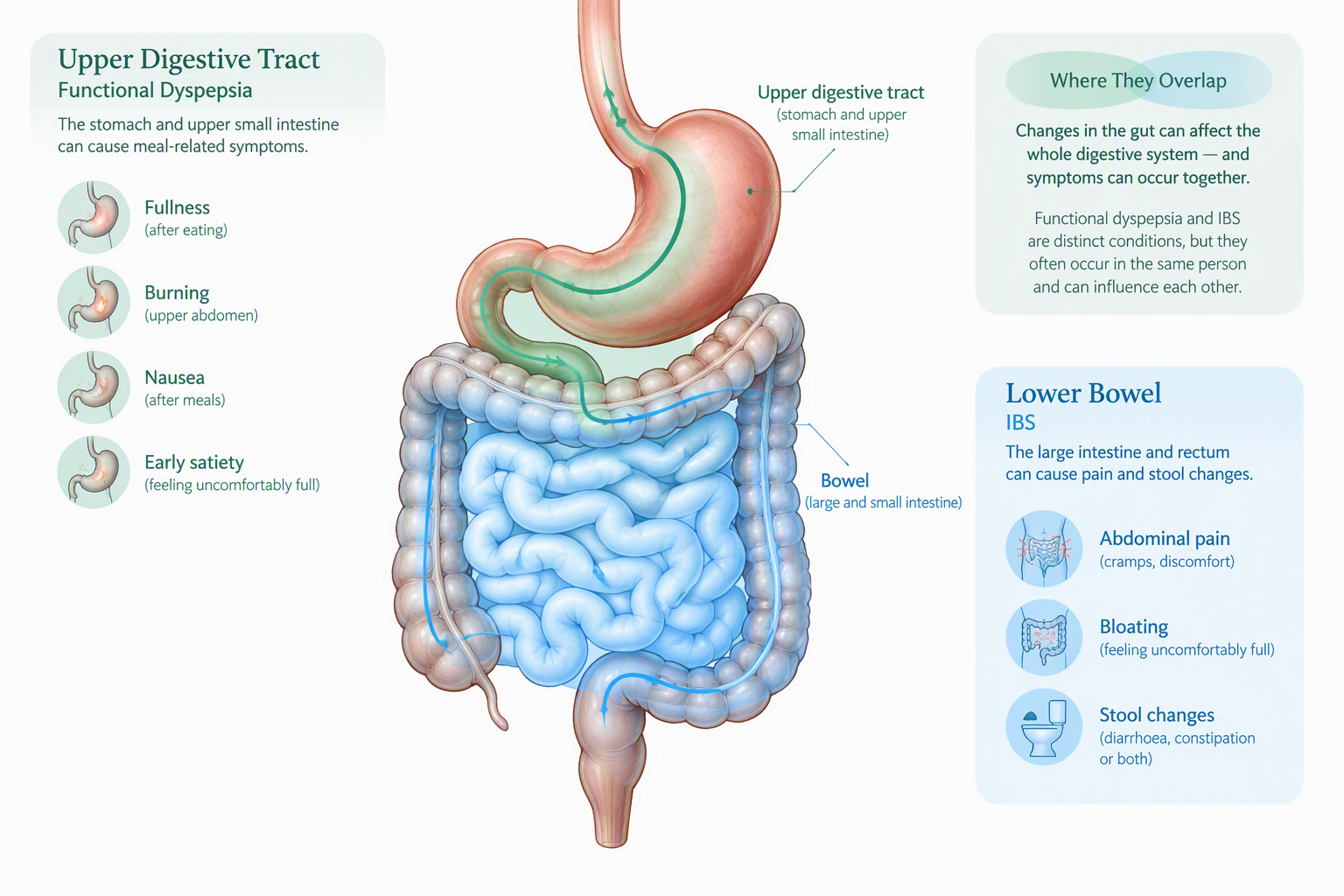 Diagram showing functional dyspepsia and IBS overlap in the upper digestive tract and bowel
