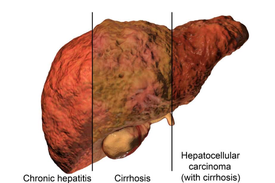 Liver with Chronic Hepatitis and Cirrhosis