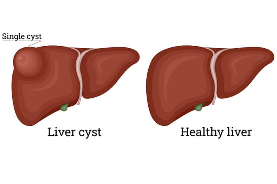 Healthy Liver vs Liver Cyst