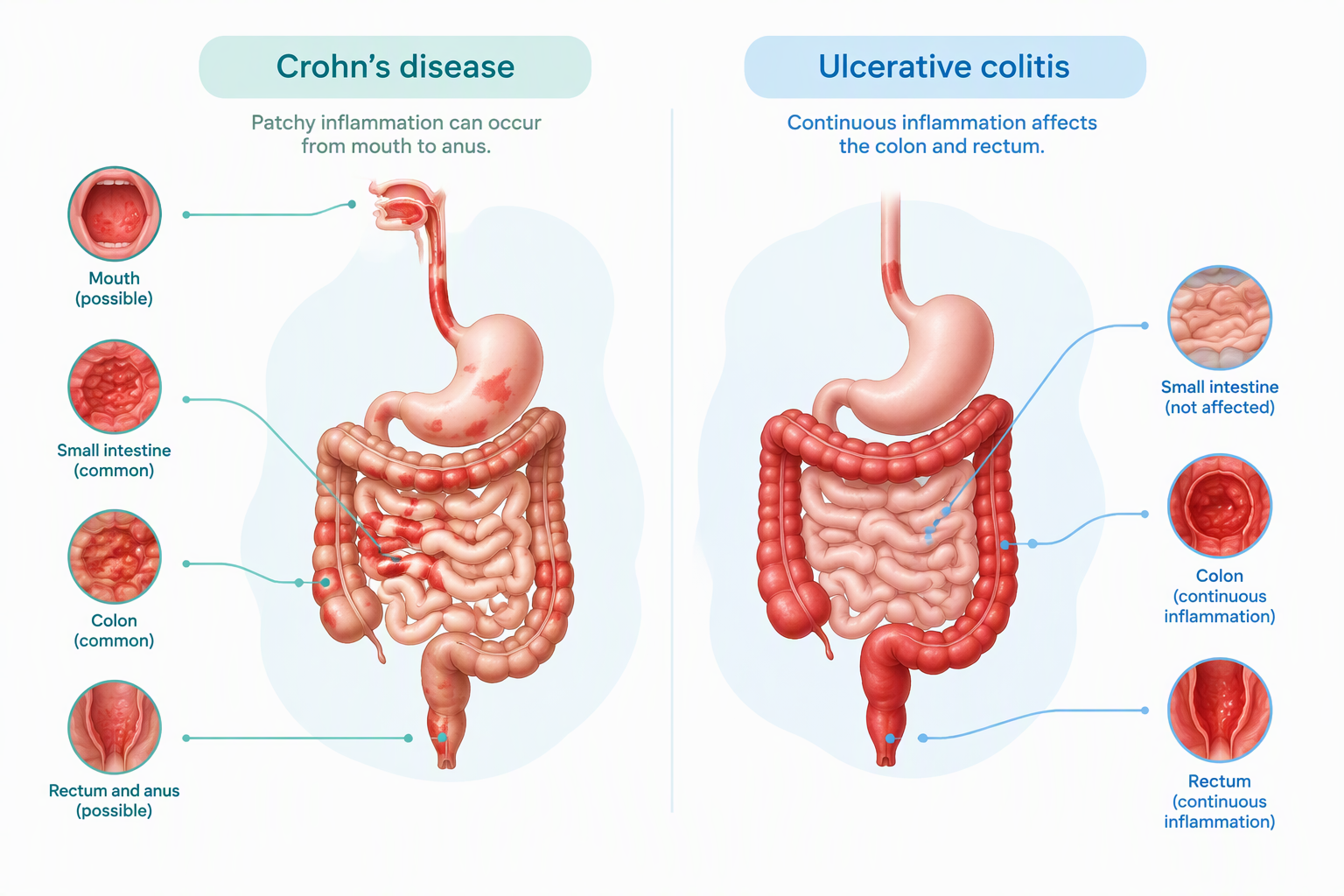 Crohn’s disease and ulcerative colitis comparison showing different inflammation patterns