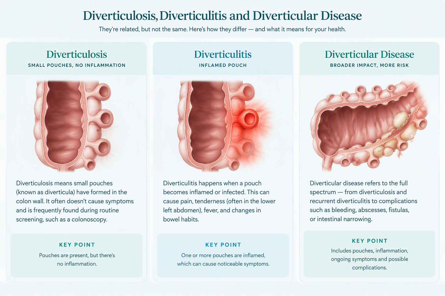 Medical illustration comparing diverticulosis, diverticulitis, and diverticular disease