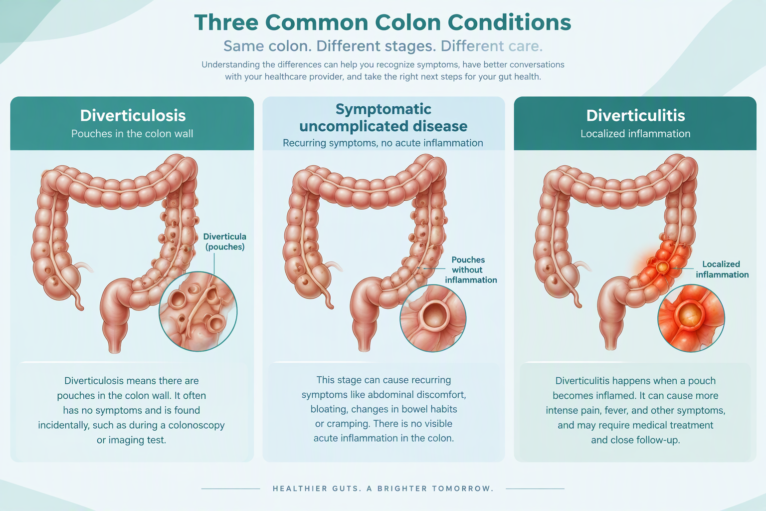 Three colon illustrations comparing diverticulosis, symptomatic disease, and diverticulitis