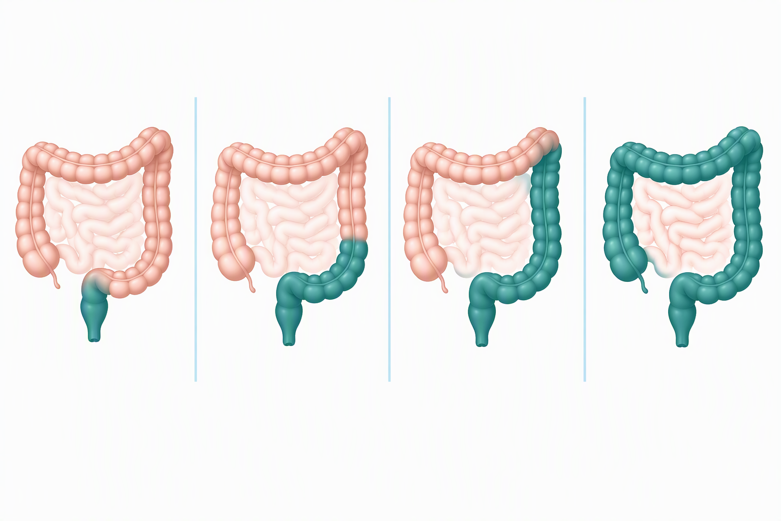 Ulcerative colitis disease extent from proctitis to pancolitis across the colon