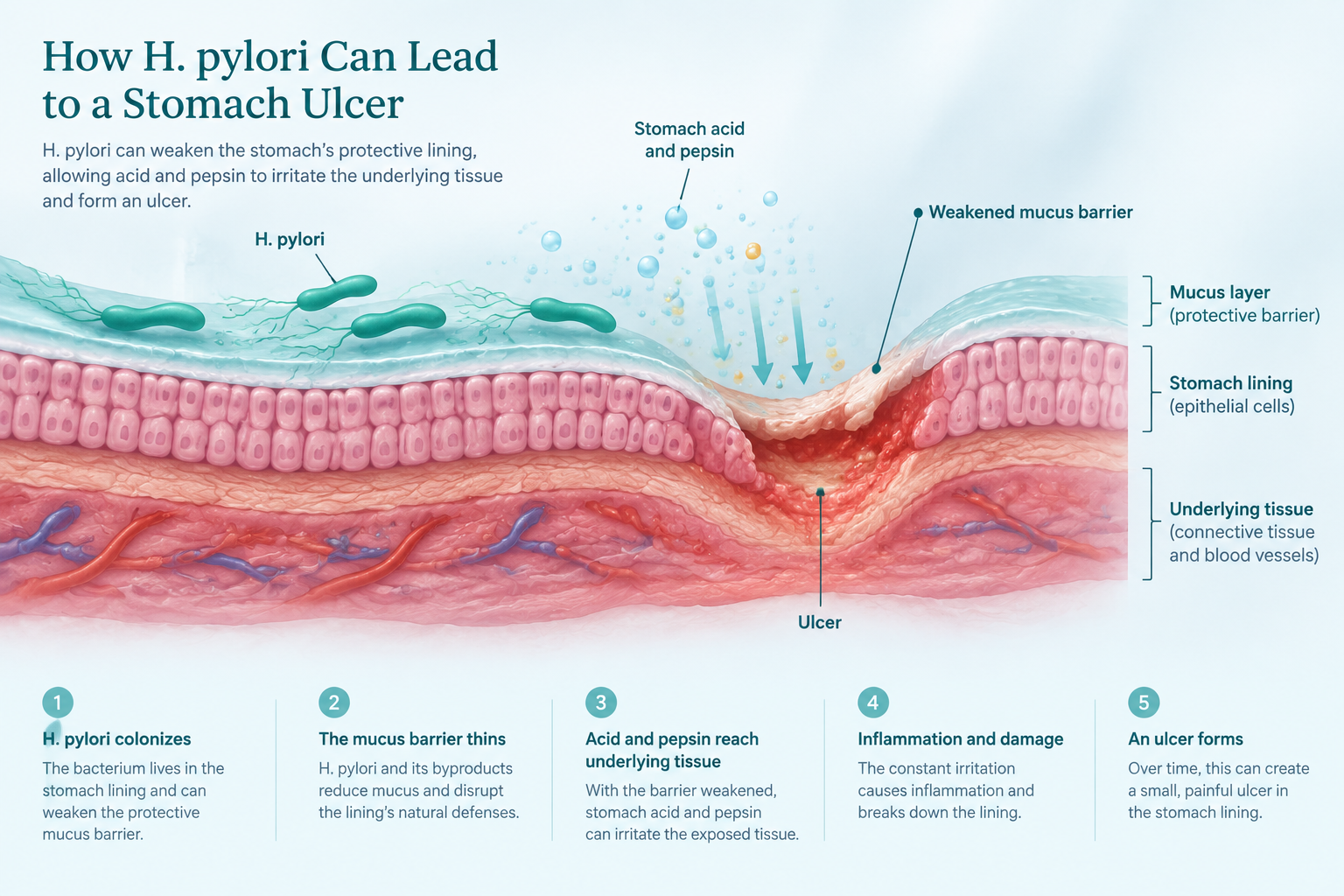 Illustration of H. pylori weakening the stomach lining and contributing to an ulcer