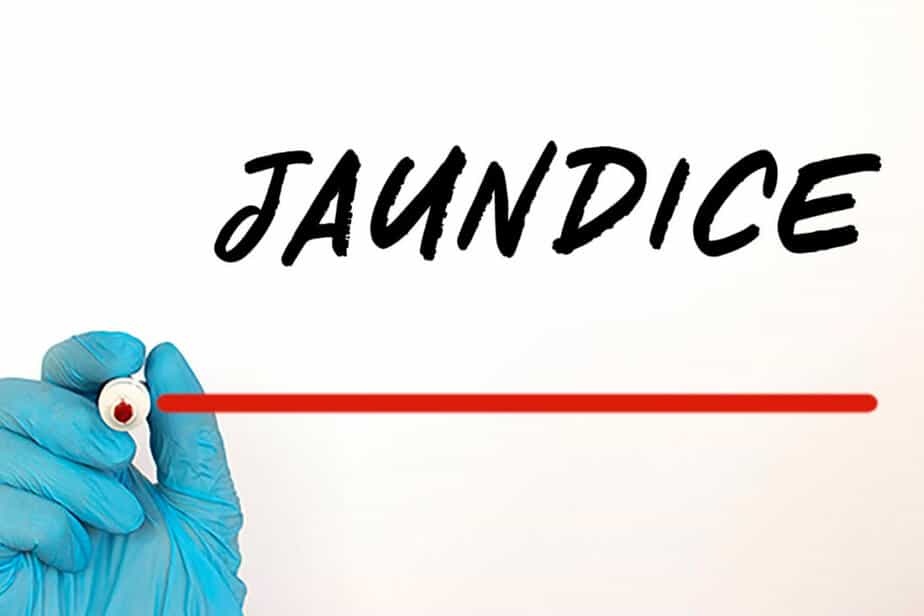 Jaundice Symptoms, Causes and Treatment