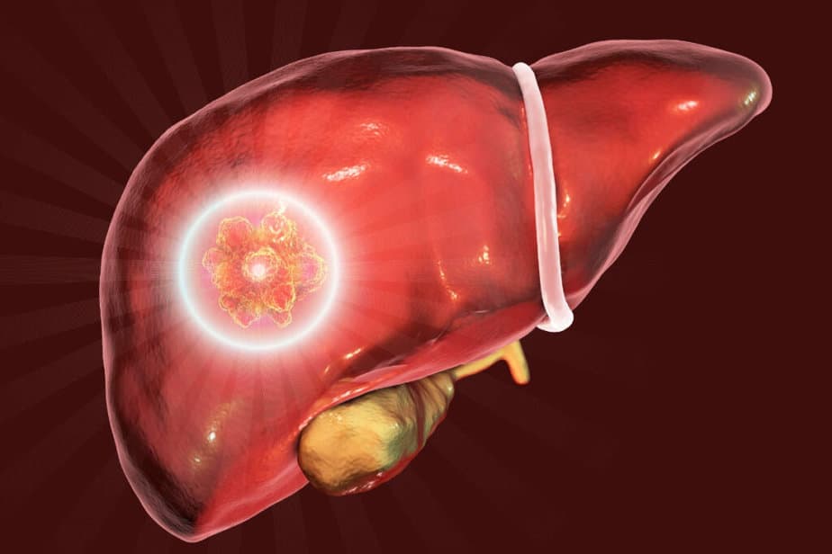 Liver Cancer Overview