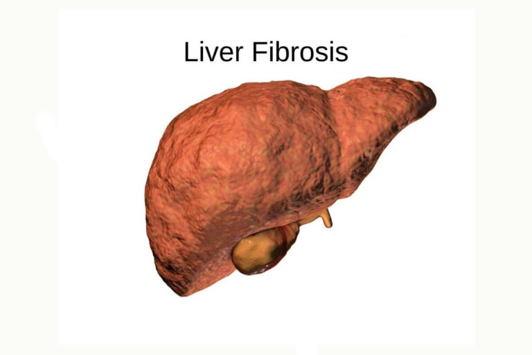 Liver fibrosis is a medical condition characterized by the excessive formation of scar tissue in the liver. It is essential to have proper liver fibrosis treatment to prevent further damage and complications.
