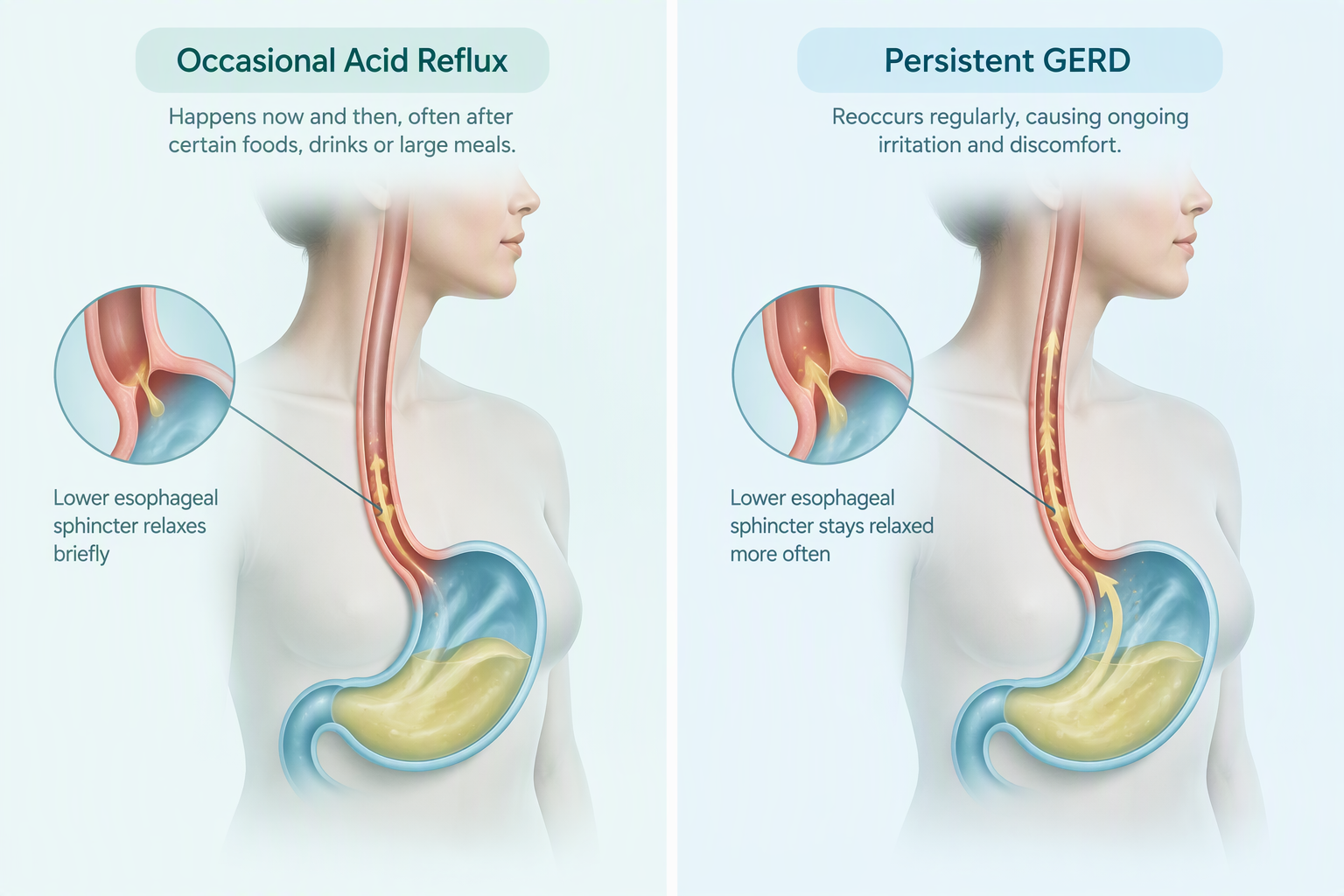 Medical illustration showing acid reflux and GERD in the esophagus