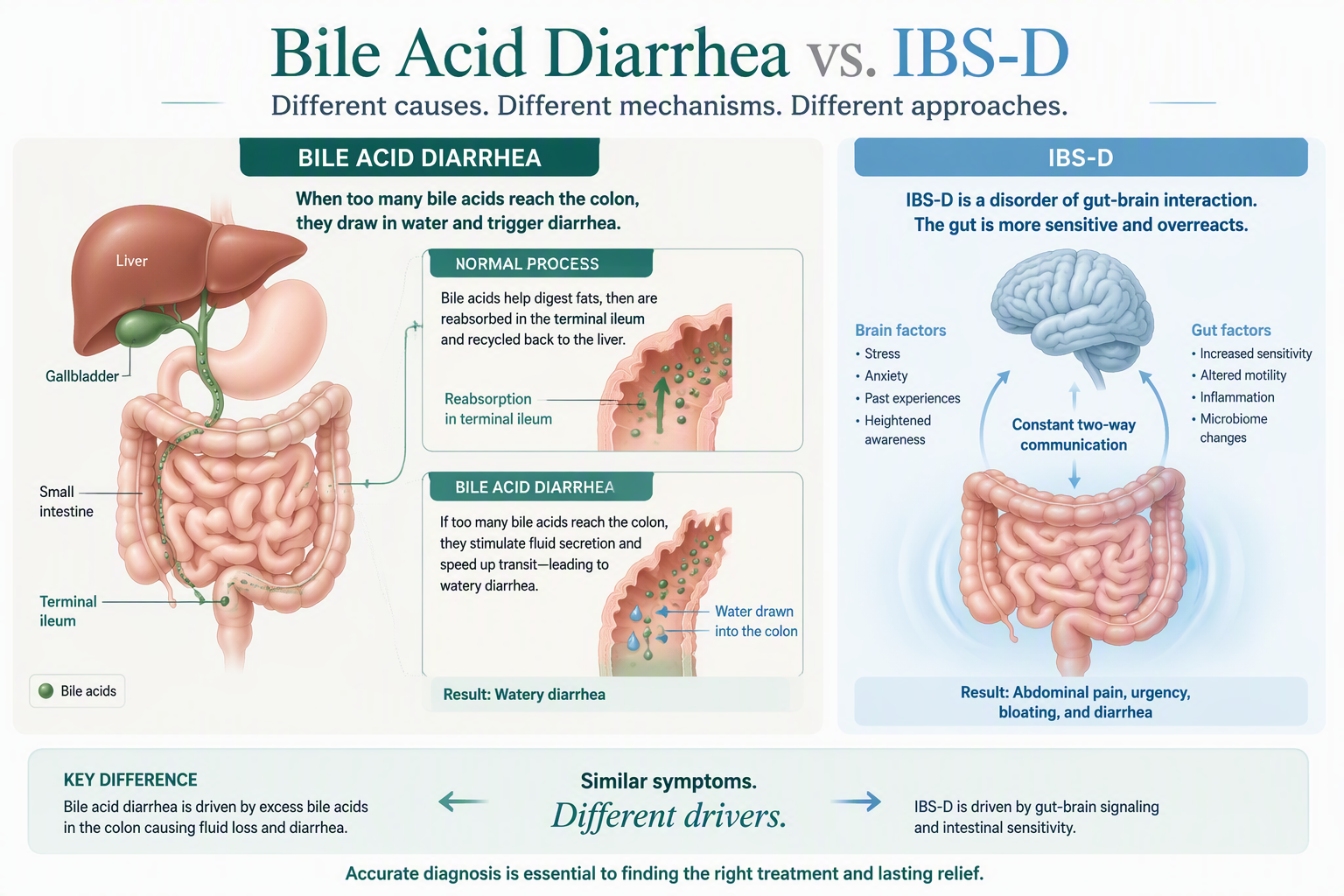 Digestive tract illustration comparing bile acid diarrhea and IBS-D mechanisms
