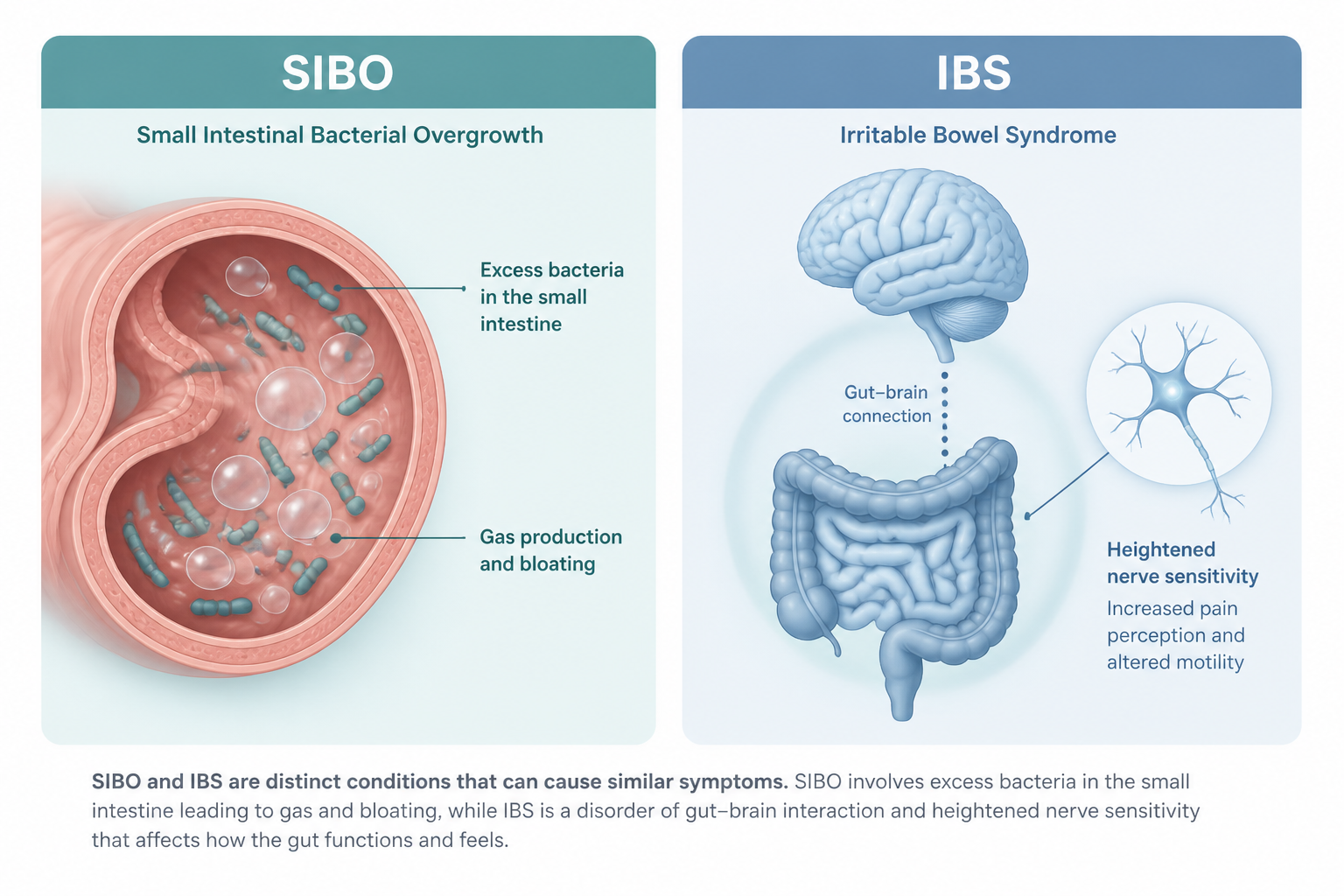 Side-by-side illustration showing SIBO bacteria in small intestine and IBS gut-brain connection