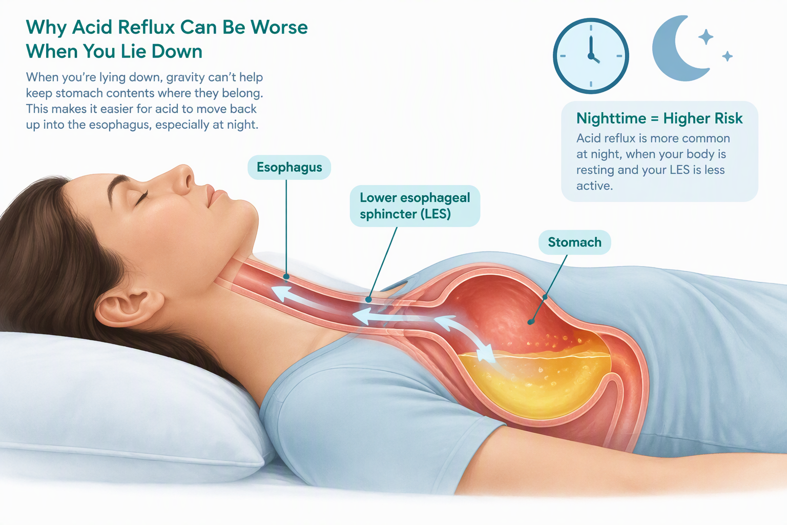 Nighttime acid reflux as stomach contents move upward when lying flat
