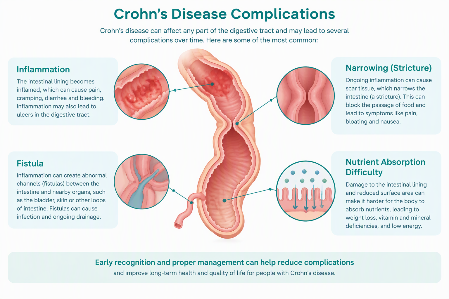 Crohn's disease complications including stricture, fistula, and inflammation