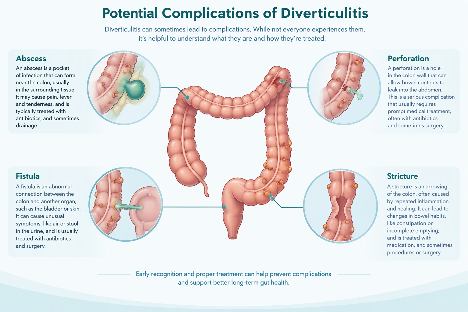 Medical illustration of diverticulitis complications including abscess, perforation, fistula, and stricture