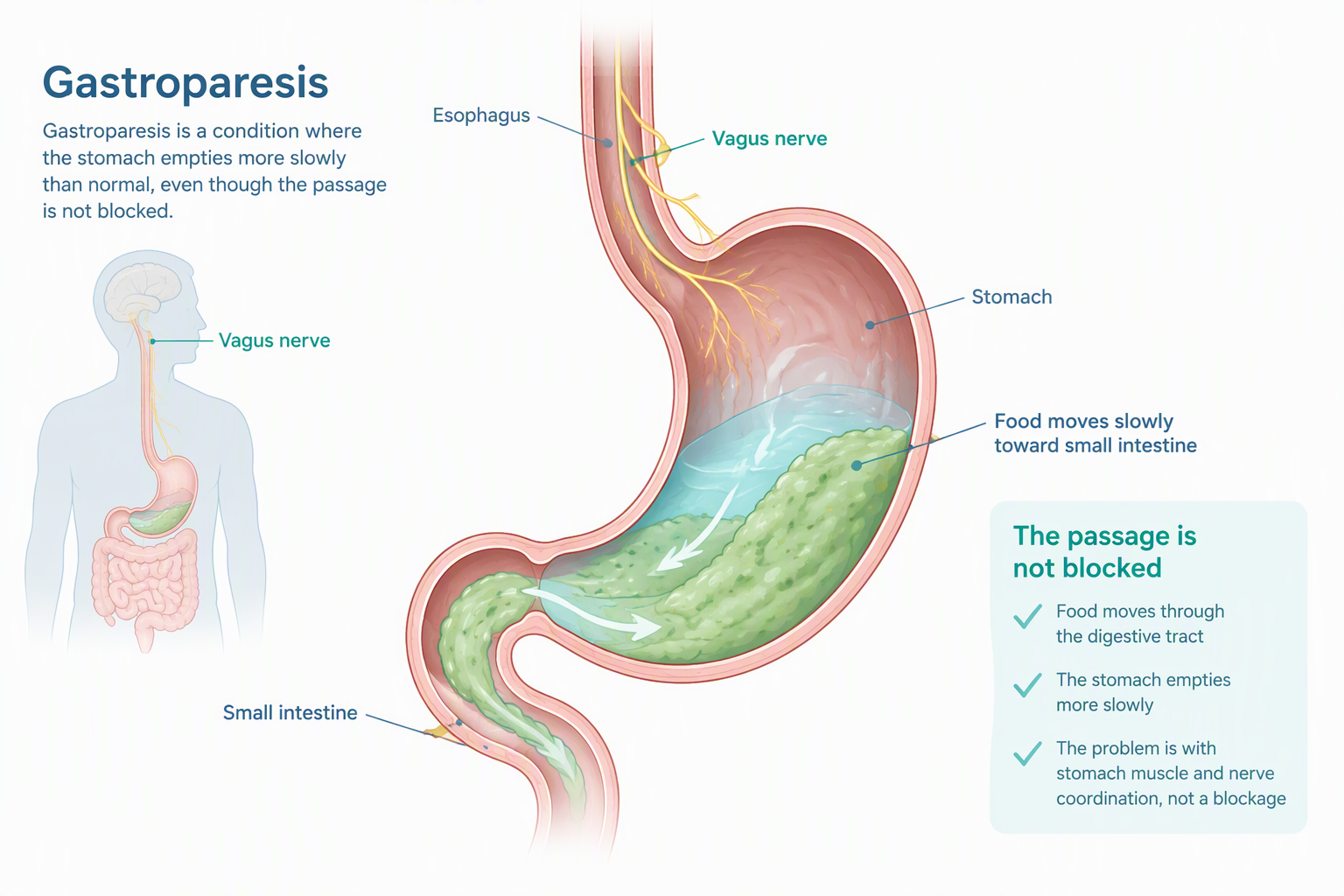 Medical illustration of delayed stomach emptying in gastroparesis without a physical blockage