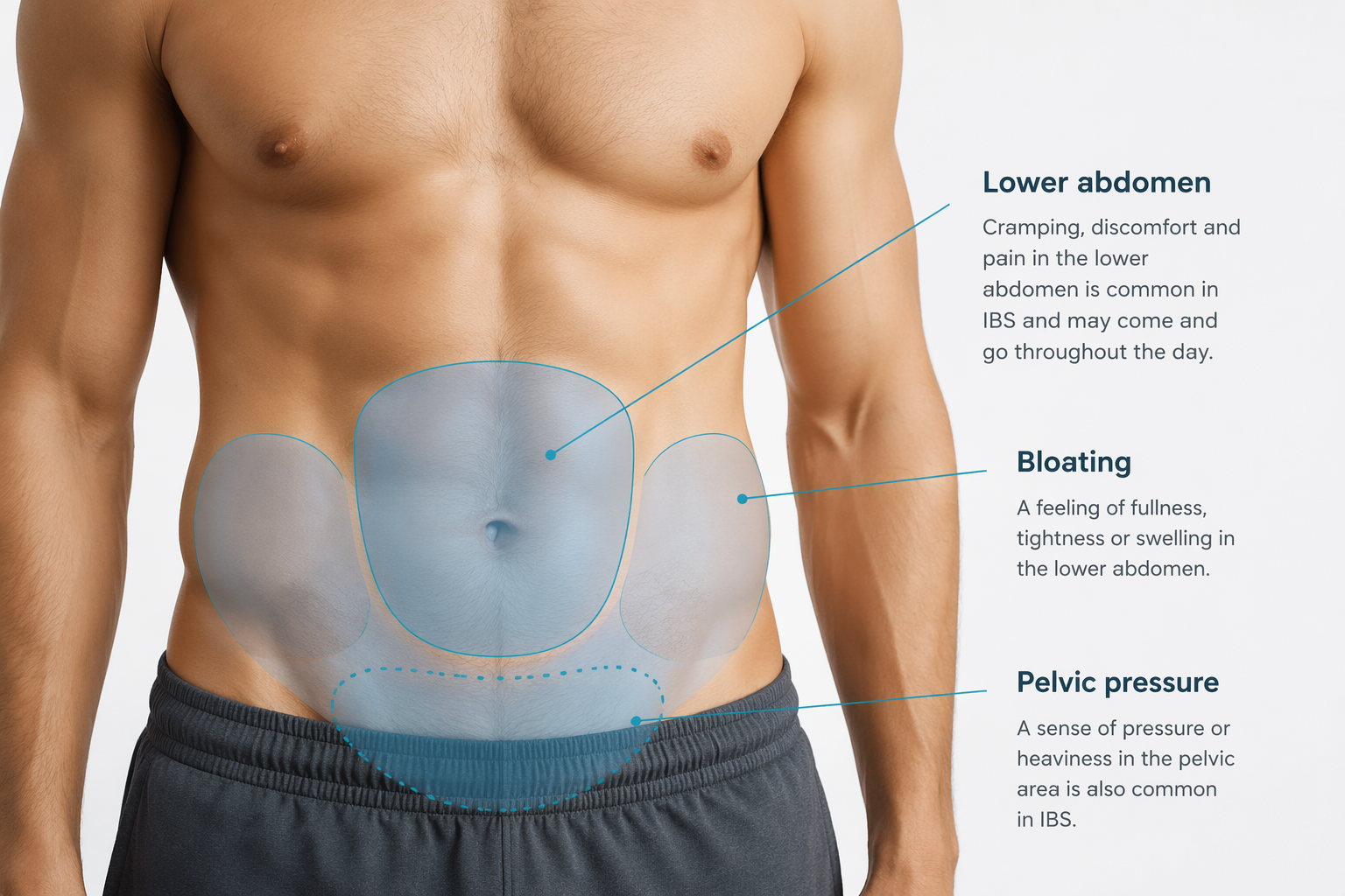Diagram of male lower abdomen showing typical IBS pain locations