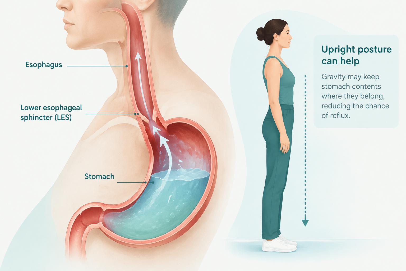 Medical illustration of acid reflux moving from the stomach into the esophagus